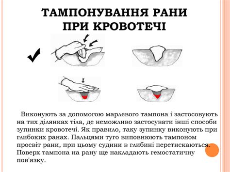Применение давления на рану